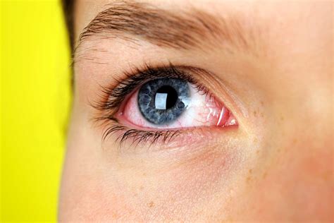 7 Silent Signs You Could Have Dry Eye Syndrome Readers Digest