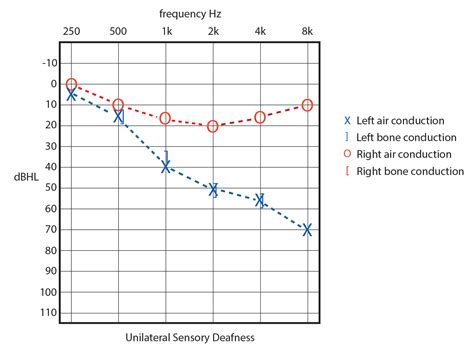 An Objective Estimation Of Air Bone Gap In Cochlear Implant Recipients