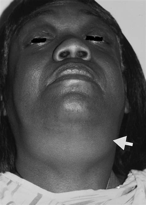 Iodide Mumps Circulation
