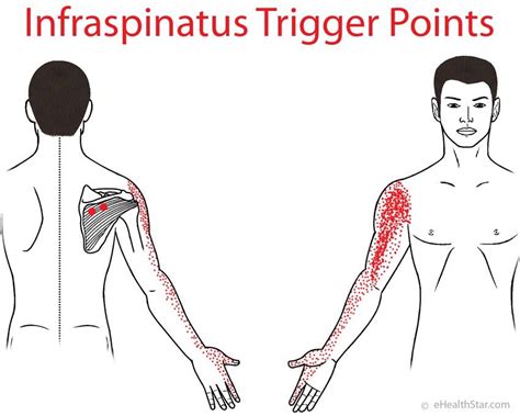 Infraspinatus Trigger Points On Anatomy