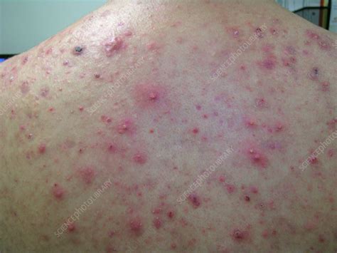 Cystic Acne Stock Image C0570642 Science Photo Library