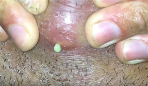 Ingrown Hair Turned Into Hard Lump Under Skin New Pimple