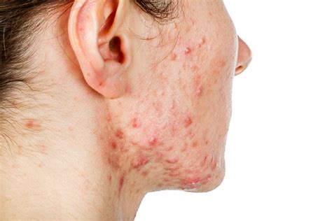 What Is Cystic Acne Causes Symptoms And Treatments