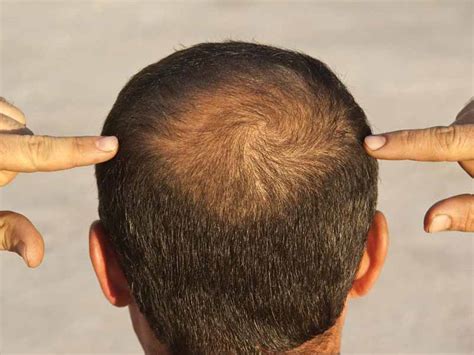 Hair Loss At The Crown Causes And Treatments Justinboey