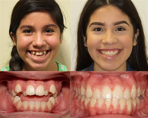 Surgical Orthodontics Advanced Orthodontics Laredo Tx