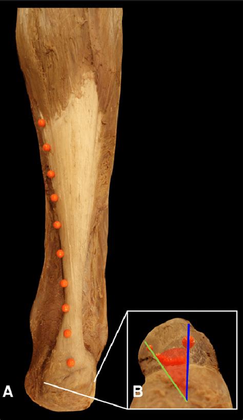 Tendon diagrams and design force vectors. Torsion of the Achilles tendon following the description of Van Gils et... | Download Scientific ...