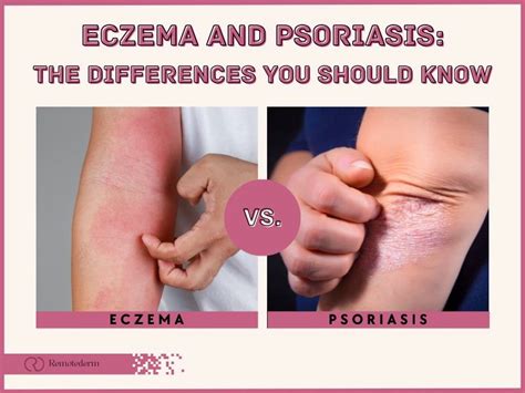 Psoriasis Vs Eczema How To Tell Them Apart Remotederm