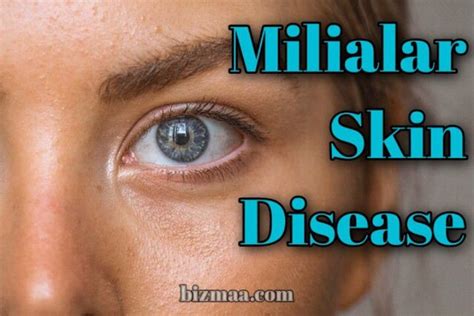 Milialar Its Causes Symptoms And Treatment