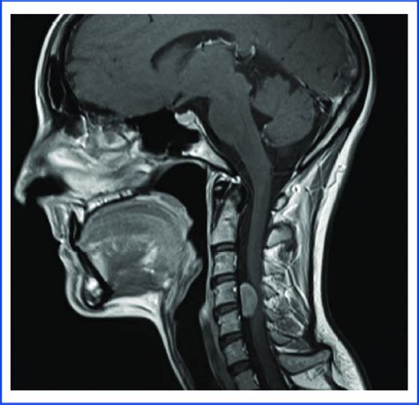 Sagittal T Mri Scan Of The Cervical Spine Showing That The Most SexiezPicz Web Porn