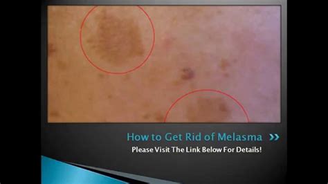 How To Get Rid Of Melasma Naturally Permanently At Home Melasma