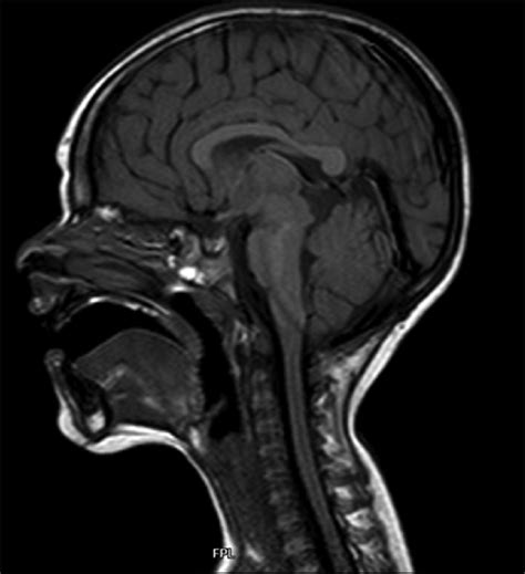 Brain T1 Weighted Sagittal Mri Performed At Four Years Of Age Showing