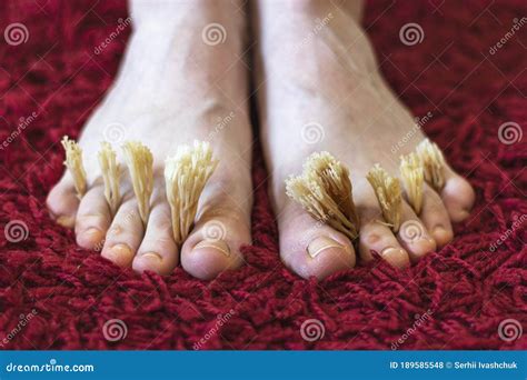 Coral Fungus Between The Toes Of Female Feet Concept Of Fungal Skin