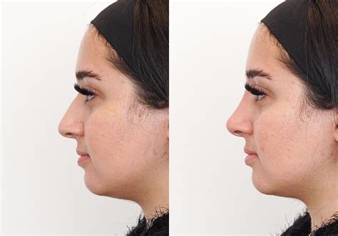 How Much Is A Non Surgical Nose Job In Canada Willene Abreu