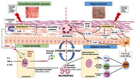 Ijms Free Full Text Generalized Pustular Psoriasis Divergence Of