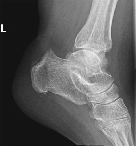 Haglund's deformity is a bony enlargement on the back of the heel. Haglund deformity | Radiology Case | Radiopaedia.org