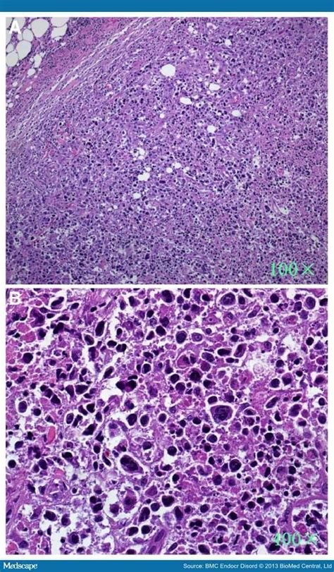 Siadh Secretion With Castlemans Disease And Lymphoma