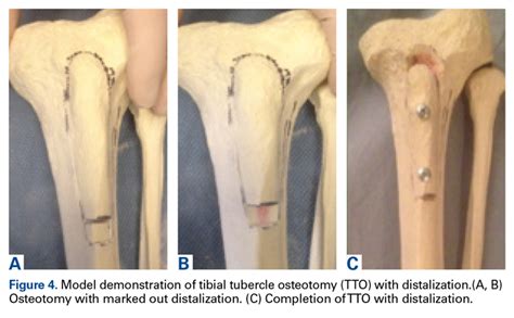 Tibial Tubercle Osteotomy Procedure