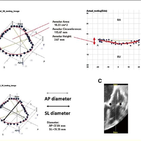 Tricuspid Annulus Reconstruction Using Realview ® With Real Time 3 D