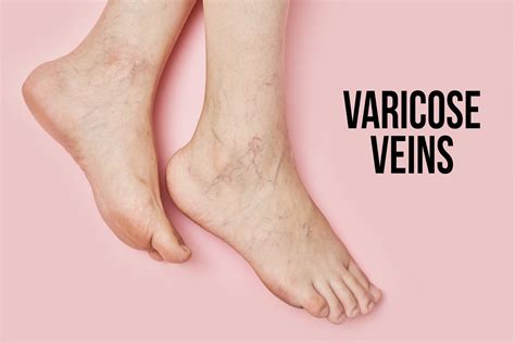 Main Causes Of Varicose Veins Top Varicose Vein Treatment Nyc