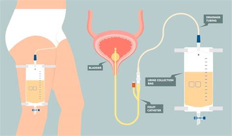 Desanimarse Continuamente Escabullirse Sonda Vesical Mujer Calibre