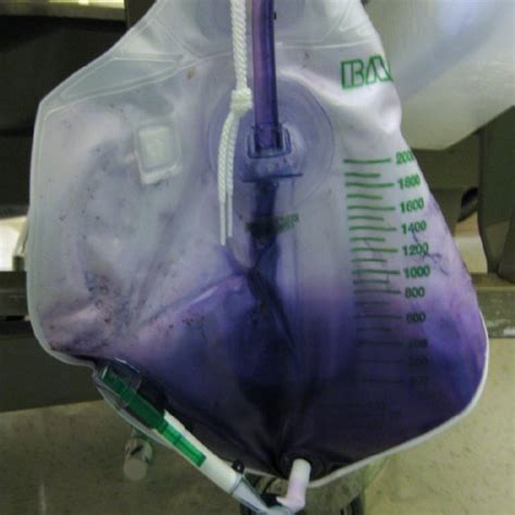 Purple Urine Noted The Foley Tubing Download Scientific Diagram