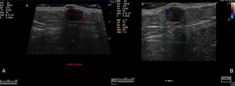 A Skin Ultrasound Shows A Well Defined Hypoechoic Lesion On The Right
