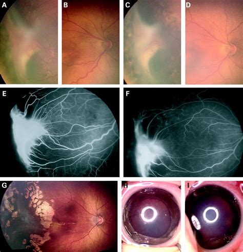 Efficacy Of Intravitreal Injection Of Bevacizumab For Severe