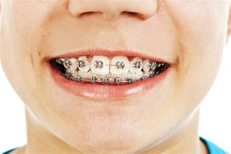 If youre wondering how to know if you need braces a discipline known as orthodontics read on for 5 simple tips to figure it out. How Do I Know If I Need Braces? - True Orthodontics, PC
