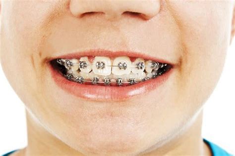 How to know if you need braces or invisalign. How Do I Know If I Need Braces? - True Orthodontics, PC