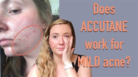 My Accutane Experience Mild Persistent Acne Youtube