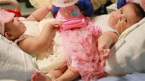 After 11 Months Together Conjoined Twins Separated During Marathon