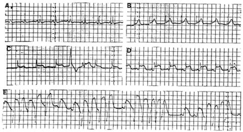 Dhps are potent arterial vasodilators. Prinzmetal Angina: ECG Changes and Clinical Considerations ...