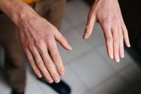 Schuppenflechte Psoriasis An Der Hand Ursachen And Behandlung