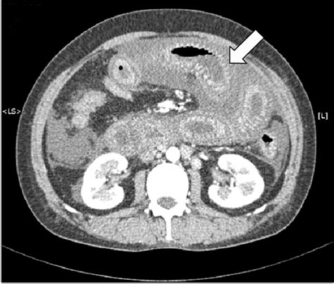 Abdominal Ct Findings On The 2nd Day Of Admission Diffuse Small Bowel