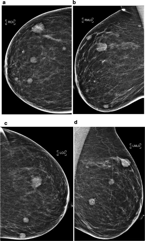 Diagnostic 2d Full Field Cc And Mlo Mammograms Of The Right Breast A