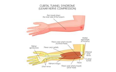 Cubital Tunnel Syndrome Definition Symptoms Causes Im