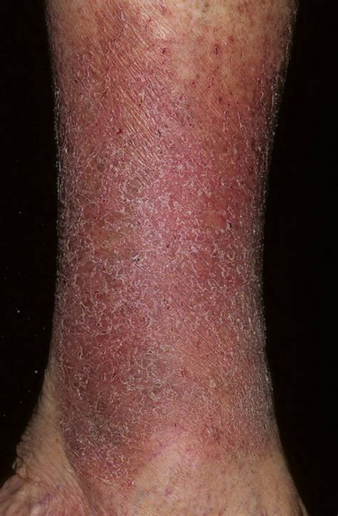 Stasis Dermatitis On Legs Pictures 174 Photos And Images