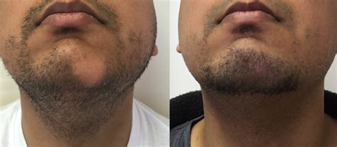 If untreated or ignored chances of regrowth are drastically decreased. Beard Bald Spot Hair Transplant - International Hair ...