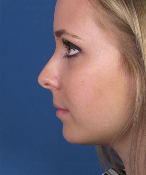 Finesse Female Cosmetic Nose Job Surgery Dr Hilinski