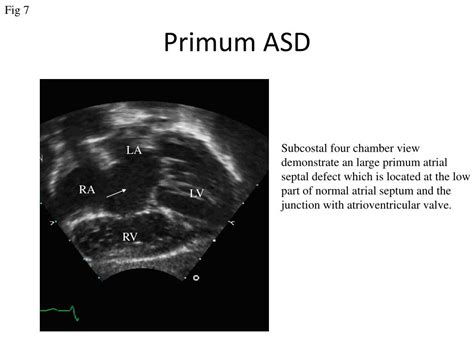Ppt Assessing The Atrial Septum Powerpoint Presentation Free