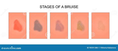 Stages Of Healing Of A Bruise Stock Vector Illustration Of Lesion