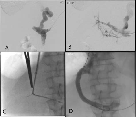 Advanced Portal Venous Access Techniques For Transjugular Intrahepatic