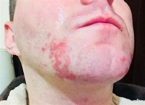 Ive Had This Rash For About 6 Months On Both Sides Of My Chin The