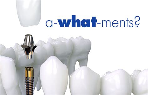 What Are Dental Implant Abutment Worcester Periodontics Blog
