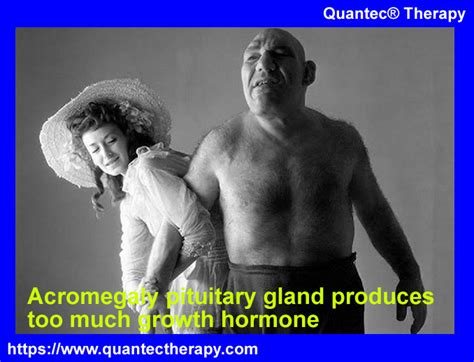 Acromegaly Pituitary Gland Produces Too Much Growth Hormone