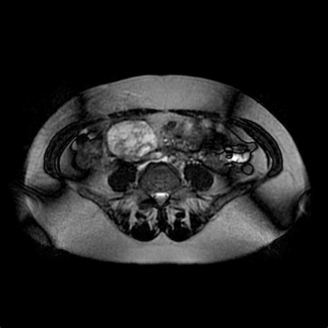 Retroperitoneal Paraganglioma Body Mr Case Studies Ctisus Ct Scanning