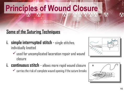Types Of Wound Closure Catalog Library
