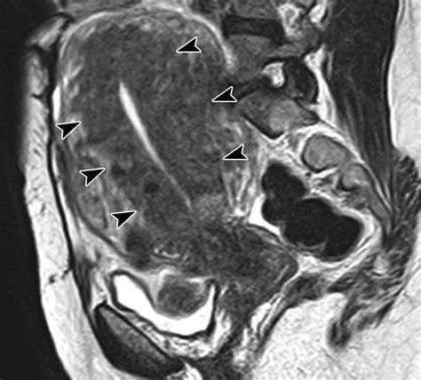 Mri Characteristics Of The Uterine Junctional Zone From Normal To The