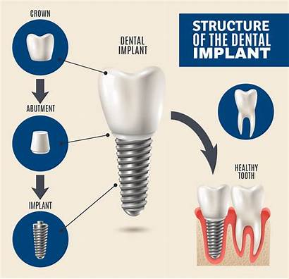 Dental Implants Implant Tooth Jacksonville Dentistry Connection