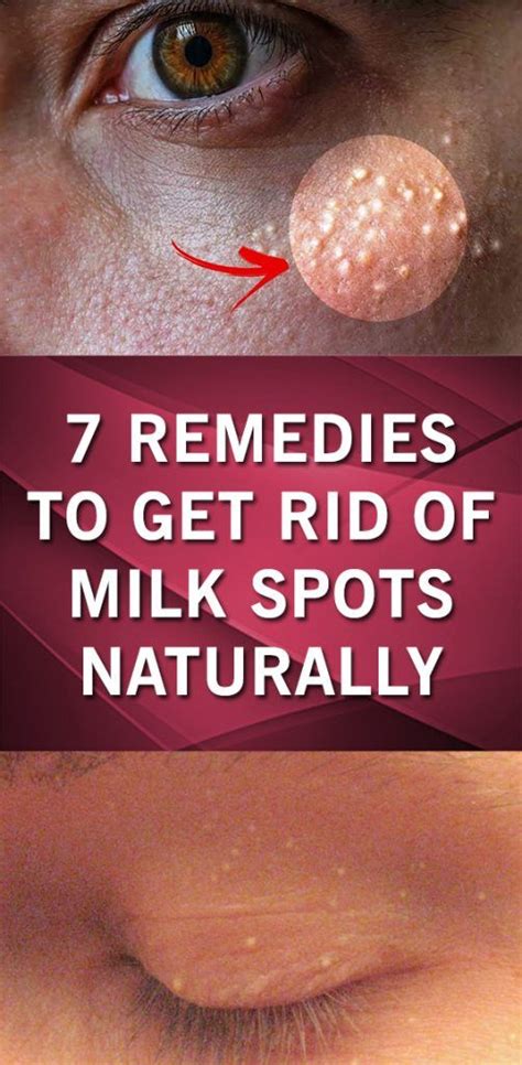 7 Remedies To Get Rid Of Milk Spots Naturally Remedies Rid How To